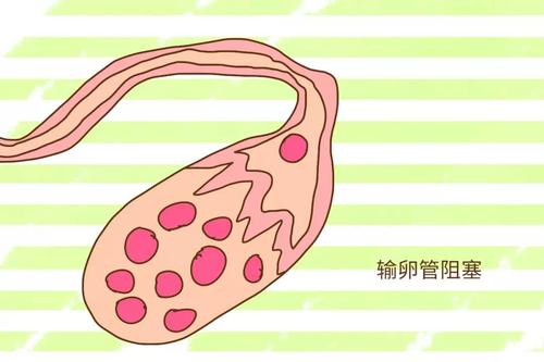 你可能還不夠了解輸卵管為什么會堵塞！