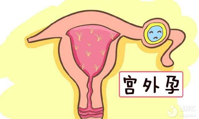試管嬰兒會增加宮外孕的幾率嗎？