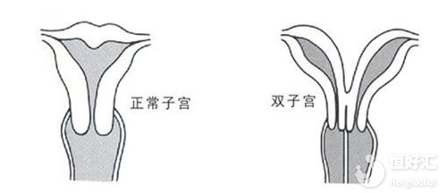 雙角子宮有哪些危害？這幾點請引起重視！