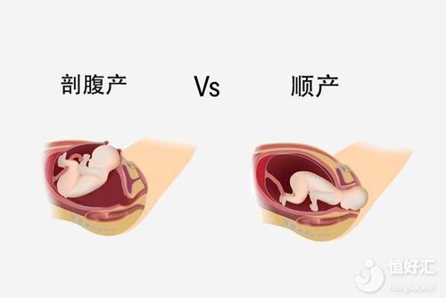 順產VS剖腹產最后誰贏了？醫生：適合的才最好