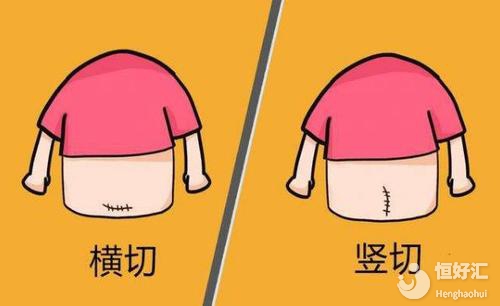 剖腹產橫切PK豎切：到底選擇哪個更好？
