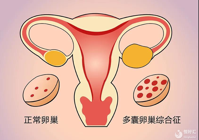 多囊卵巢綜合征嚴(yán)重嗎？治療多囊你要了解它！