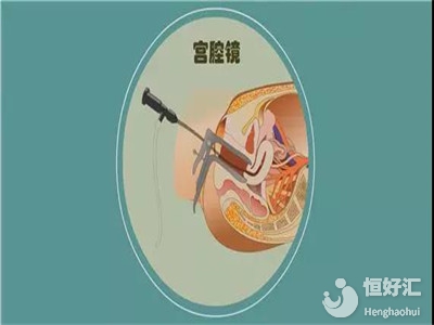 試管嬰兒需要做宮腔鏡檢查嗎？看完這個才知道