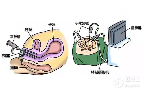 試管嬰兒為什么要做宮腔鏡檢查？醫(yī)生告訴你