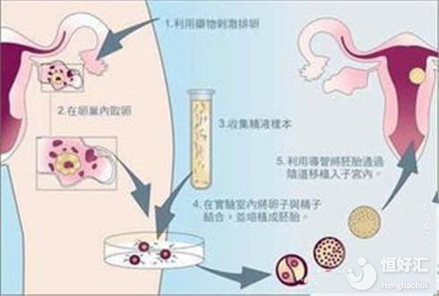 海外試管嬰兒有什么優勢？這5點很明顯
