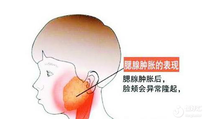 腮腺炎對(duì)生育有影響嗎?男性需注意!