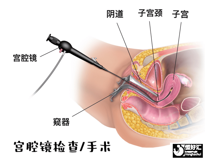 宮腔分離注意事項有哪些，導致宮腔分離的原因是什么?