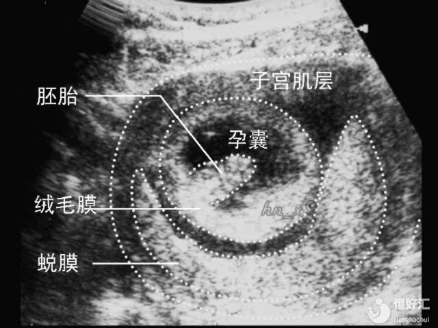 生化妊娠是什么，生化妊娠會排出孕囊嗎？生化后多久可以懷孕？