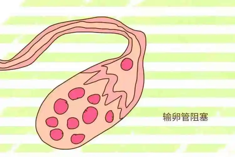 輸卵管為何會(huì)阻塞？有什么預(yù)防措施？