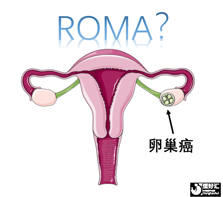 卵巢癌有什么癥狀？哪些人群是易得卵巢癌？